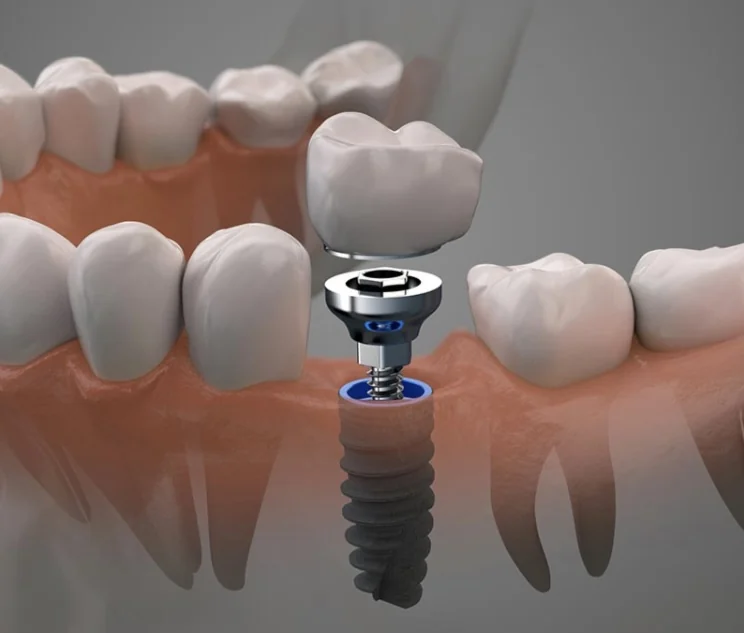 Diagram of a dental implant: post, abutment and crown